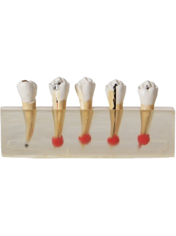 DENTAL DISEASE MODEL 
