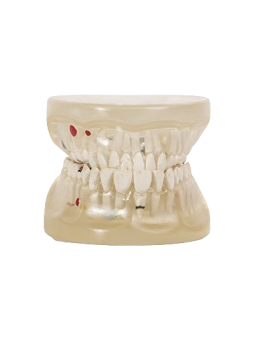 TRANSPARENT DENTAL PATHOLOGY MODEL 